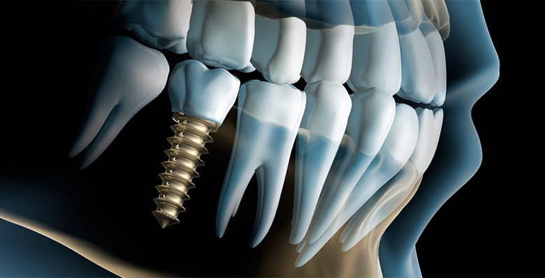 Dentadura Completa con 4 implantes